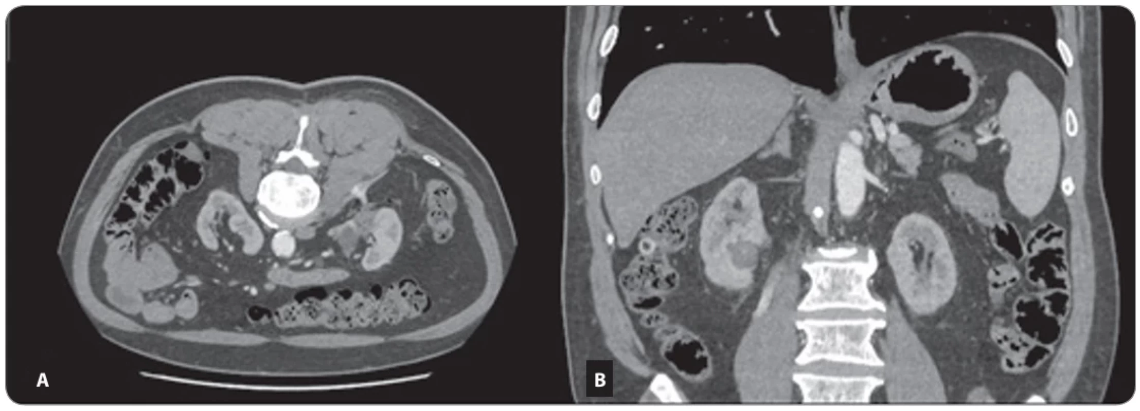CT axial scan (A) and coronal reconstruction (B) in arterial phase showing complete tumor necrosis without any signs of tumor  remnants or immediate complications.