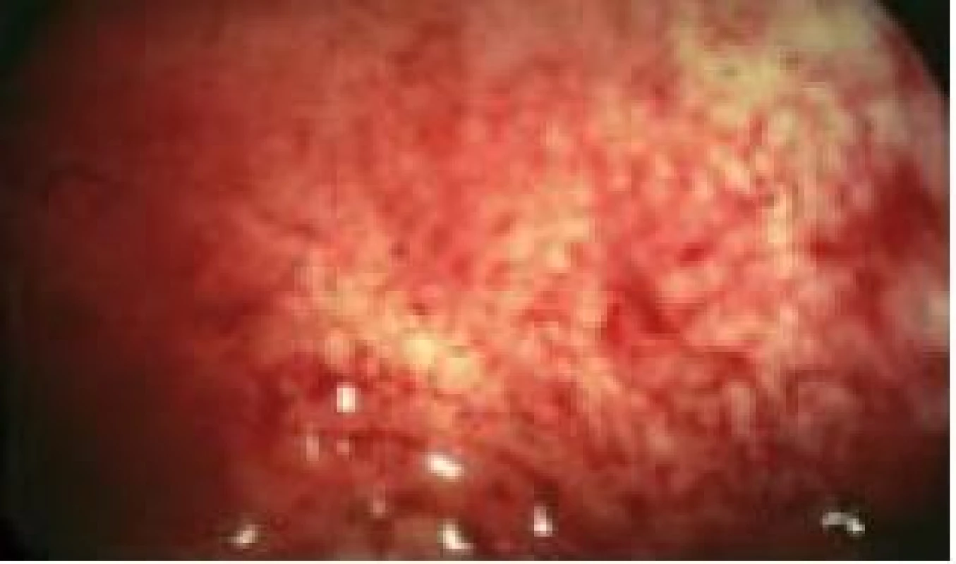 Endometritis.