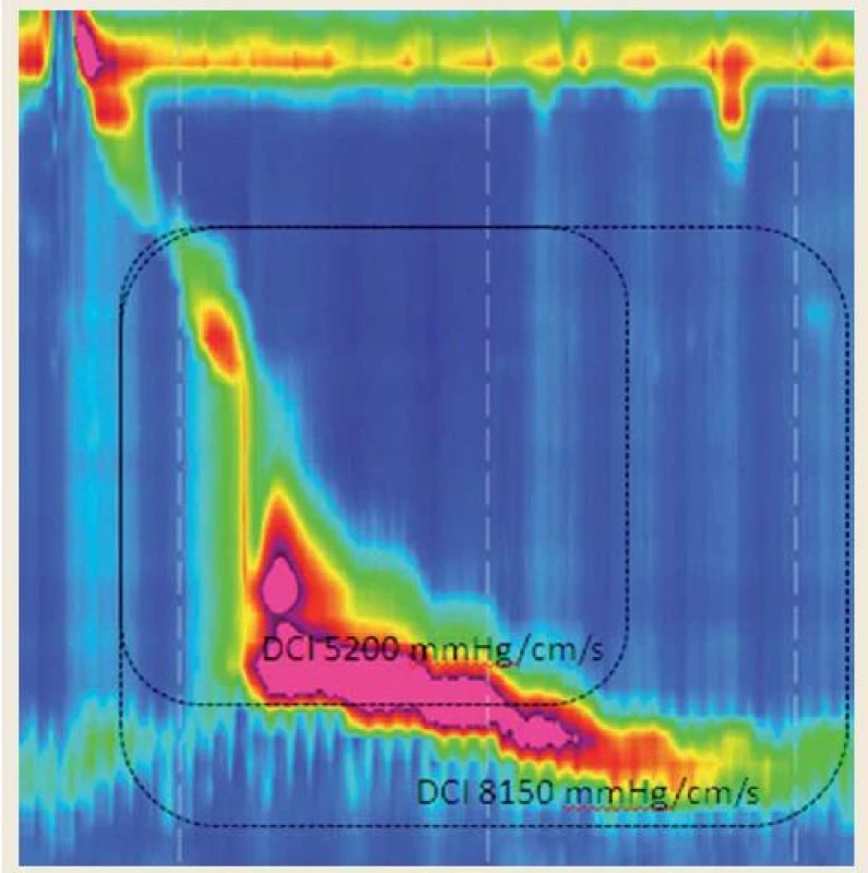Hyperkontraktilita postihujúca aj oblasť dolného pažerákového zvierača. Jeho zahrnutie do hodnotenia vedie k zvýšeniu DCI nad hornú hranicu normy.
Fig. 7. Hypercontractility affecting the lower esophageal sphincter. Its incorporation into DCI calculation results in hypercontractility with DCI exceeding the upper limit of a norm.