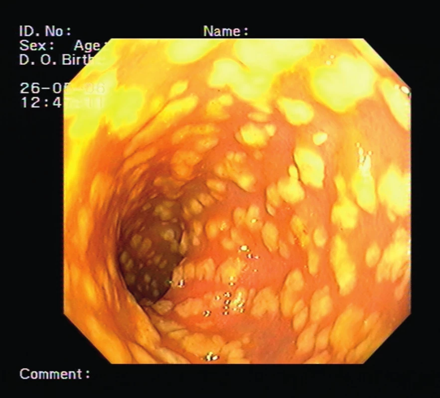 Endoskopický obraz nejtěžší formy infekce <i>Clostridium difficile</i> – pseudomembranózní kolitida (ilustrativní snímek, archiv Oddělení endoskopických metod a sonografie Thomayerovy nemocnice)