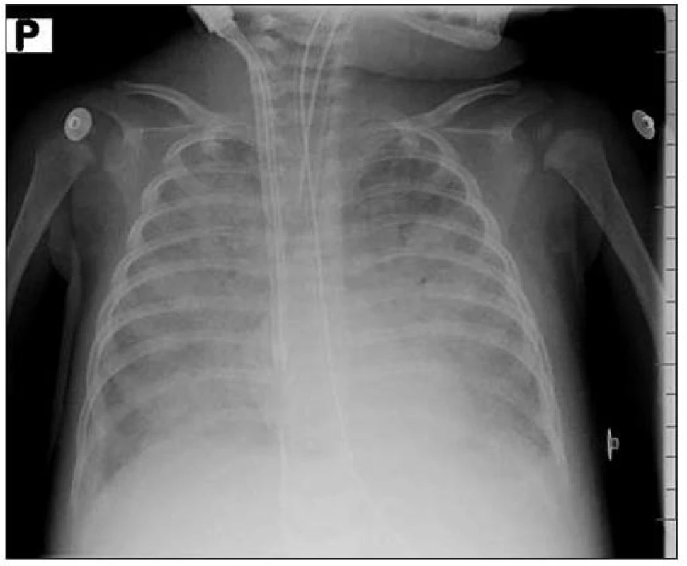 RTG nález 2. den u pacientky č. 3.
Fig. 1. X-ray finding 2nd day in female patient No. 3.