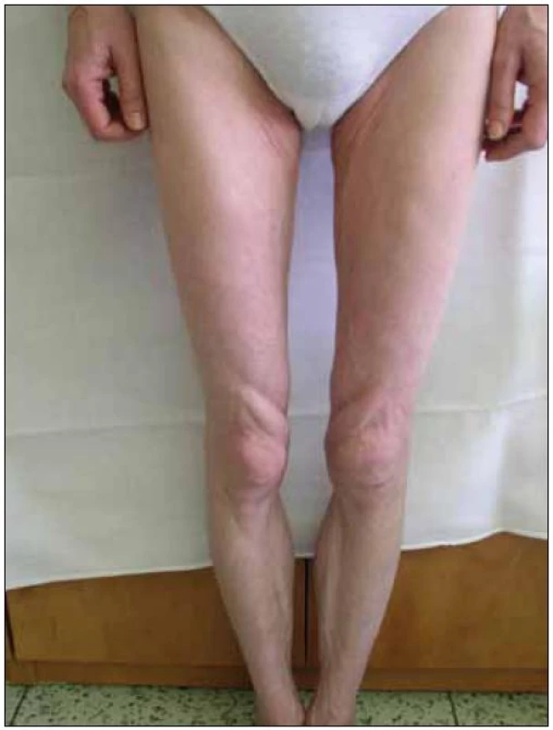 Lipoatrofie na dolních končetinách.