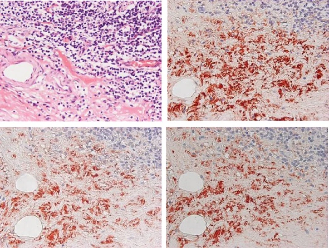 Immunohistological findings of the intestine tissues. Exacerbated intestine mucosal infiltration of lymphocytes and plasma cells with Hematoxylin-Eosin staining (a). Immunostaining of total IgA (b), IgA<sub>1</sub> (c), IgA<sub>2</sub> (d) in submucosal layer of intestine