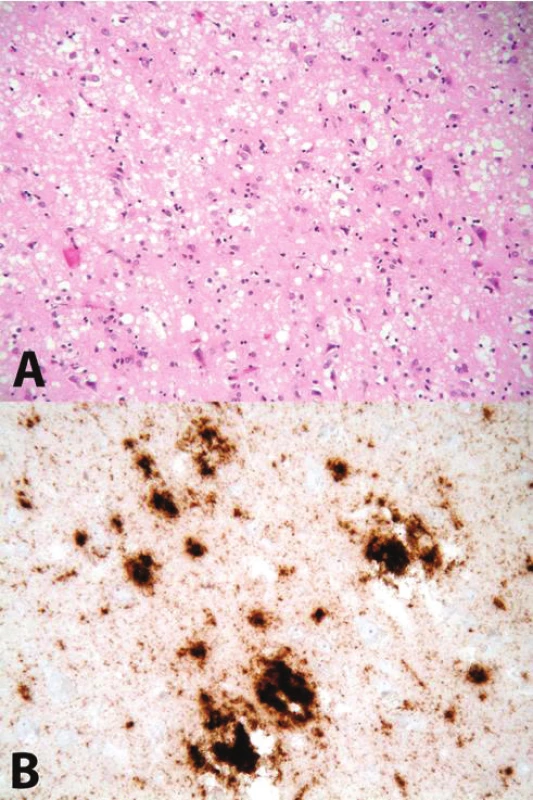 A. Obraz spongiformní dystrofie (spongióza, glióza, úbytek neuronů) Barveno hematoxylinem-eosinem, zvětšení 200x; B imunohistochemická reakce znázorňující depozita PrP<sup>res</sup>, použita protilátka 6H4, zvětšení 400x
Fig. 1 A Spongiform dystrophy (spongiosis, gliosis, neuronal loss), hematoxylin-eosin stain, 200x magnification; B immunohistochemical detection of PrP<sup>res</sup> deposits, anti-PrP anibody 6H4 used, 400x magnification