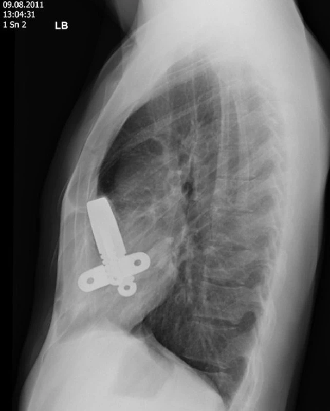 Dislokace dlahy 3 týdny po Nussově operaci
Fig. 6: Bar displacement 3 weeks after the Nuss procedure