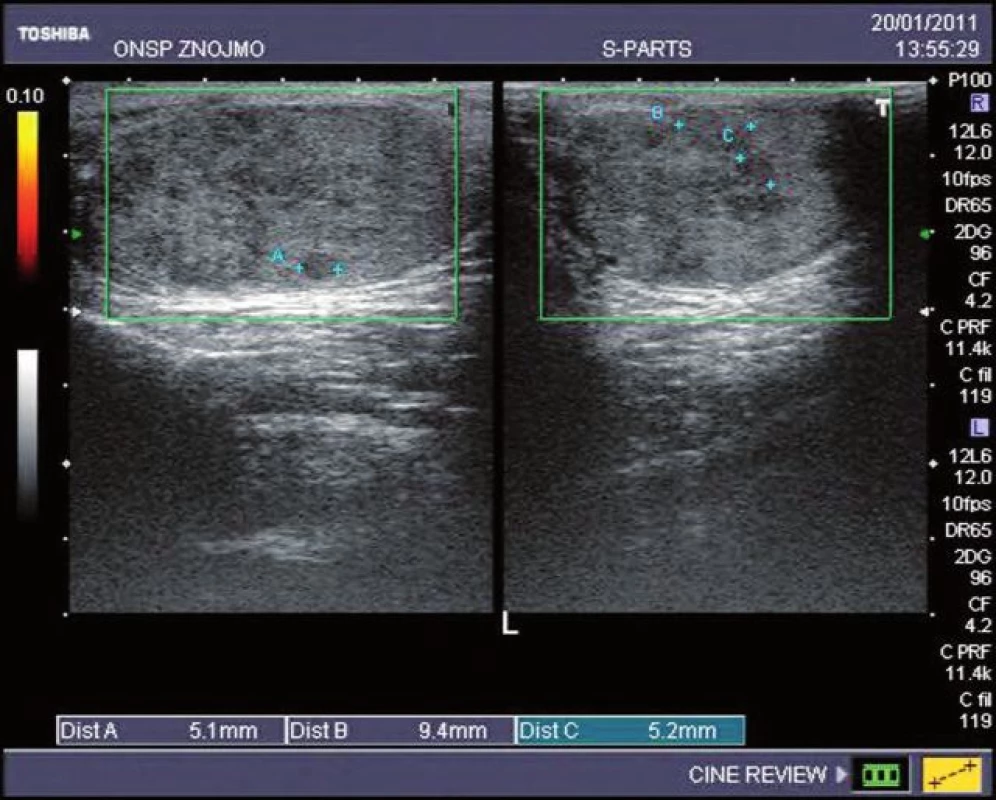 USG varlat – nález nádorové infiltrace varlete
Fig. 1. USG testis – finding of testicular tumour infiltration
