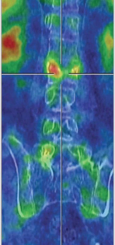 Fúze SPECT/CT krevního poolu v koronárním řezu – zvýšený v obratlovém těle L2.