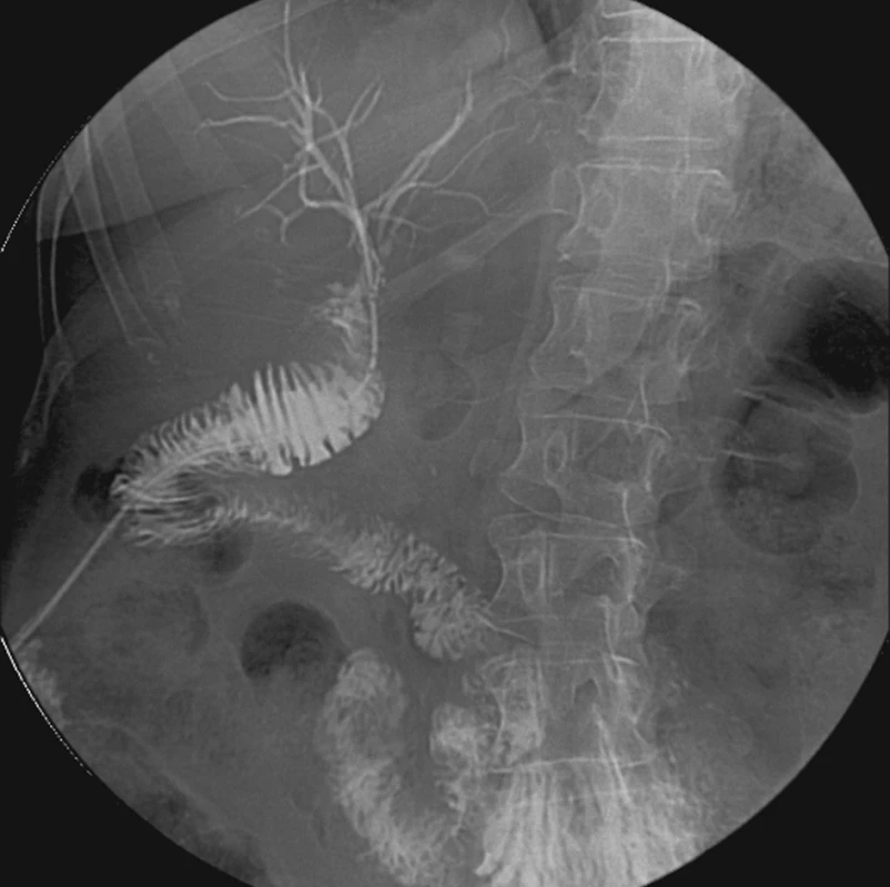 Biligrafie transanastomotickým Voelckerovým drénem
Fig. 1. Biligraphy using the transanastomotic Voelcker drain