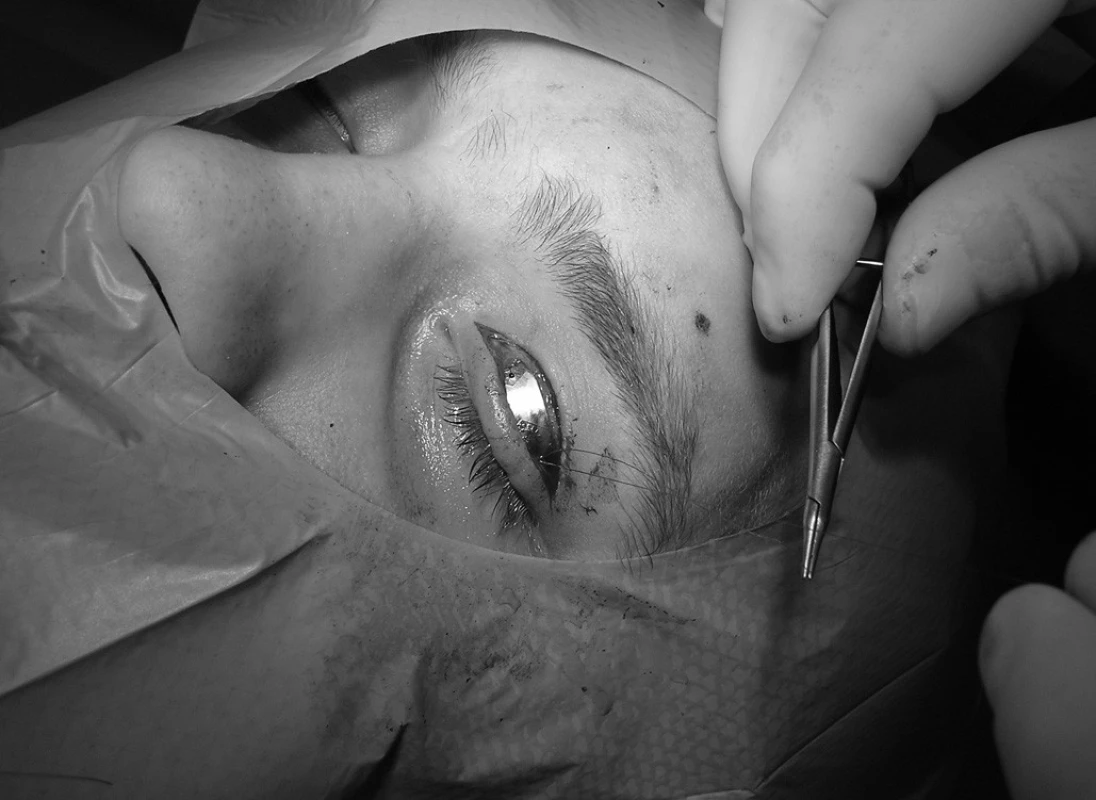 Závěrečná pozice implantátu na horním víčku