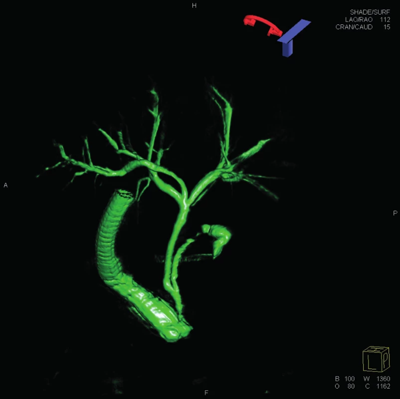 3D ERCP
Fig. 6: 3D ERCP