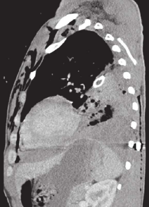 Lacerace dolního laloku levé plíce, fluidotorax, malý perikardiální výpotek − sagitální řez
Fig. 3: Lower left lobe laceration, fluidothorax, small pericardial effusion − sagittal section