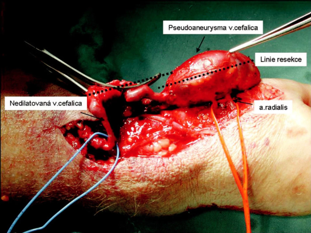 Preparace pseudoaneuryzmatu
Fig. 6. Preparation of the pseudoaneurysm