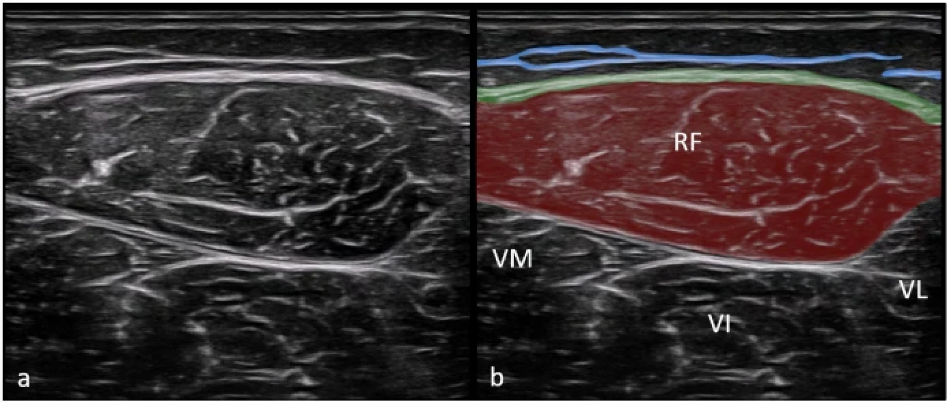 Zobrazení fascia lata v lokalizaci anterior na nativním sonografickém snímku (a) a na barevně zvýrazněném sonografickém snímku (b). Superficiální fascie (modrá linie) je jasně viditelná a odděluje od sebe povrchovou a hlubokou podkožní tukovou tkáň. Hluboká fascie (zelená linie) přechází přes svalové bříško m. rectus femoris (červená).  Fig. 4. Imaging of the fascia lata on the anterior location in the original ultrasound image (a) and in a color-enhanced ultrasound image (b). The superficial fascia (blue line) is clearly visible separating the adipose tissue into superficial and deep layers. The deep fascia is represented by a green line over the rectus femoris muscle belly (red). 