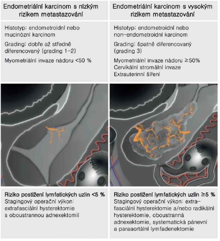 Rozlišení endometriálního karcinomu s nízkým a vysokým rizikem metastázování podle předoperační histologie a ultrazvuku s následnou optimální volbou stagingového výkonu