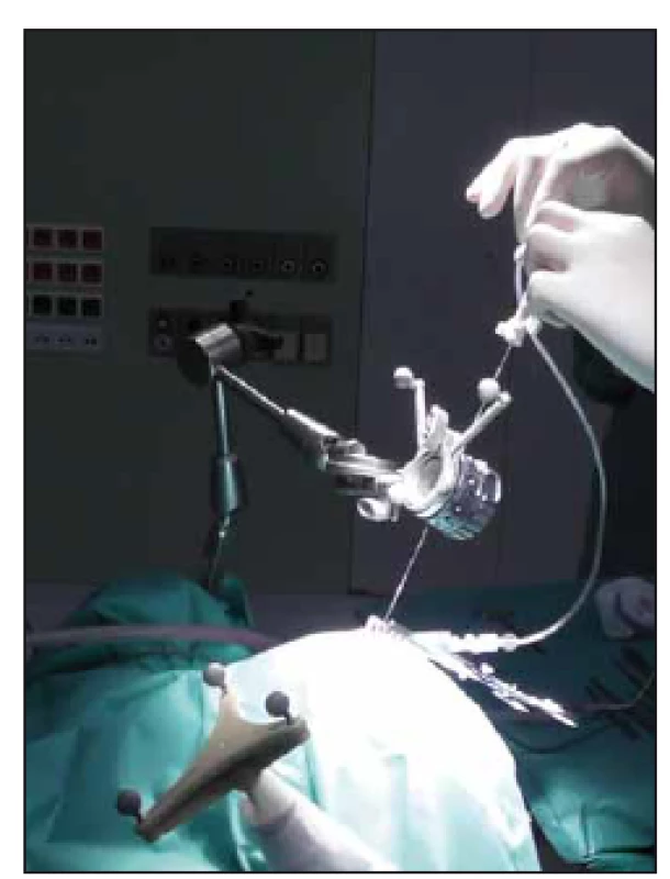 Adjustovaný systém Varioguide nad operačním polem. Zavádění bioptické jehly dle připravené trajektorie.
Fig. 6. Adjusted Varioguide system during surgery. Biopsy needle insertion according to planned trajectory.