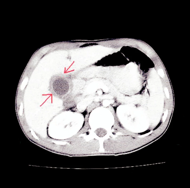 CT snímek – obraz cholecystitidy a pericholecysticidy s normálním obrazem v oblasti duodena
Fig. 6. CT view – Cholecystitis and pericholecystitis with a normal picture in the duodenal region