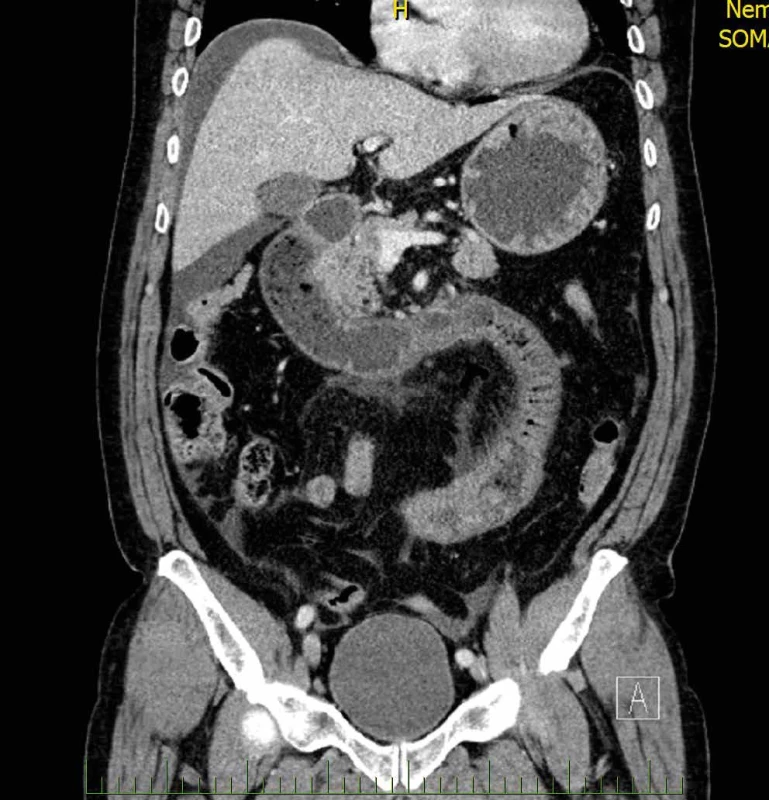 CT břicha, pneumoperitoneum, perforovaný vřed duodena Fig. 3: Abdominal CT, pneumoperitoneum, perforated duodenal ulcer