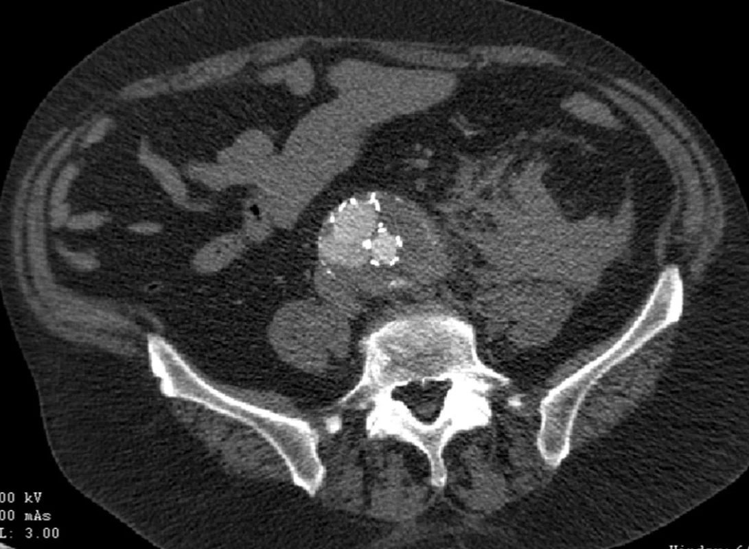 CTA obraz distálního endoleaku I.typu pravé nožičky s rupturou vaku do levého retroperitonea
Fig. 7: CTA image of the distal type I endoleak of aright leg with a rupture into the left retroperitoneum