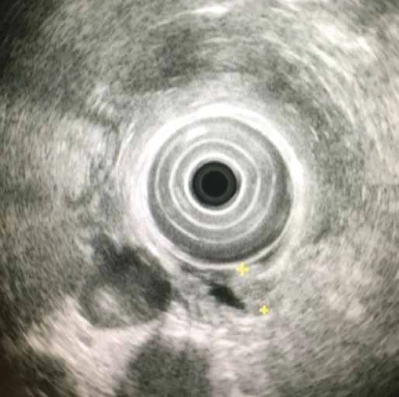 Endosonografické zobrazenie granulárnobunkového tumoru ezofagu u 49-ročného prezentovaného pacienta. Tumor je ohraničený žltými krížmi.
Fig. 2. An endosonographic (EUS) view of oesophageal granular cell tumour in the 49-year-old presented patient. The tumour is marked by yellow crosses.