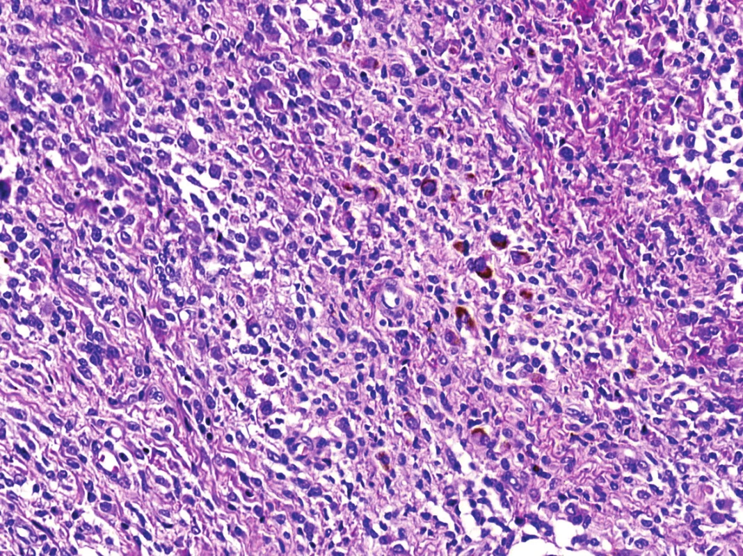 Převládající difúzní mozaikovitá, uniformní mononukleární stromální složka s roztroušeným hrudkovitým hemosiderinovým pigmentem (HE, 200x).