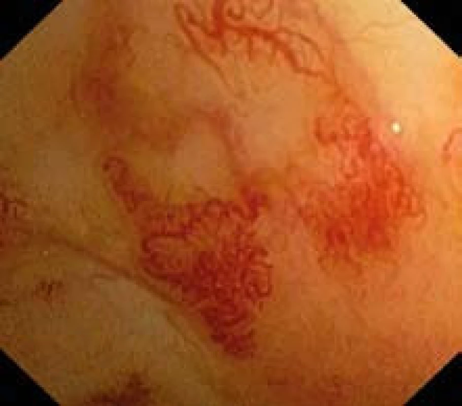 Teleangiektázie sliznice rekta – detail.
Fig. 1. Telangiectasia of the rectum mucosa – detail.