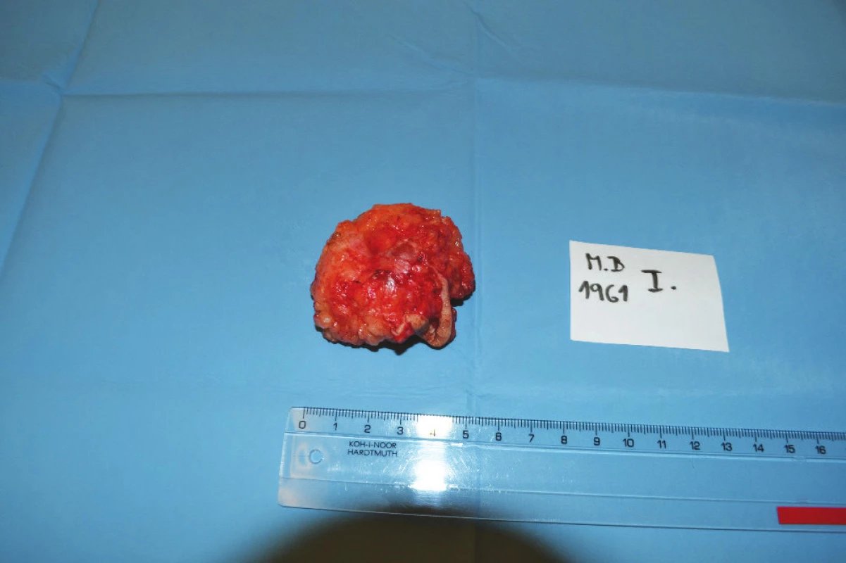 Infiltrát v jizvě po předchozí laparotomii
Fig. 1: Infiltrate in the scar after previous laparotomy