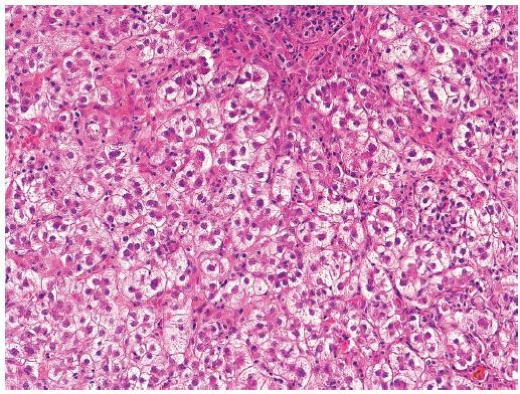 Fibrocholestatická hepatitida typu C u pacienta po transplantaci jater. Mírná zánětlivá celulizace portálních polí s převahou polynukleárů. Nápadně zduřelé cholestatické hepatocyty uspořádané do cholestatických rozet.
HE, objektiv 10x.