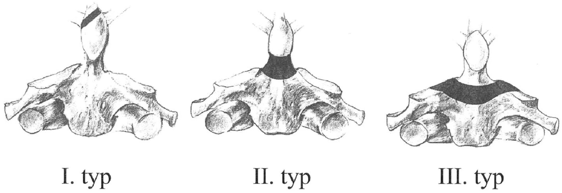 Klasifikace podle Andersona-D‘Alonza
Fig. 1. Anderson-D’Alonzo classification
