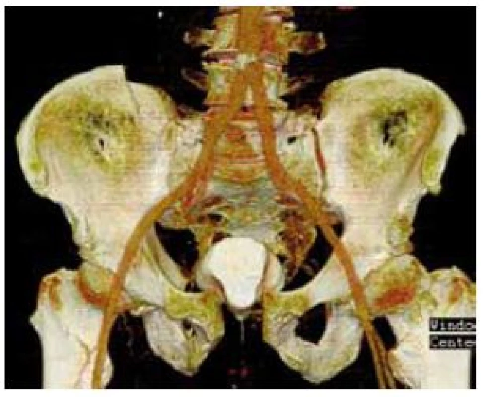 CT pánve (koronární řez v 3D zobrazení) – diastáza symfýzy s patrným prolapsem močového měchýře
Fig. 7. CT of pelvis (coronal section in 3D) – picture shows diastasis symphysis with prolaps of the urinary bladder