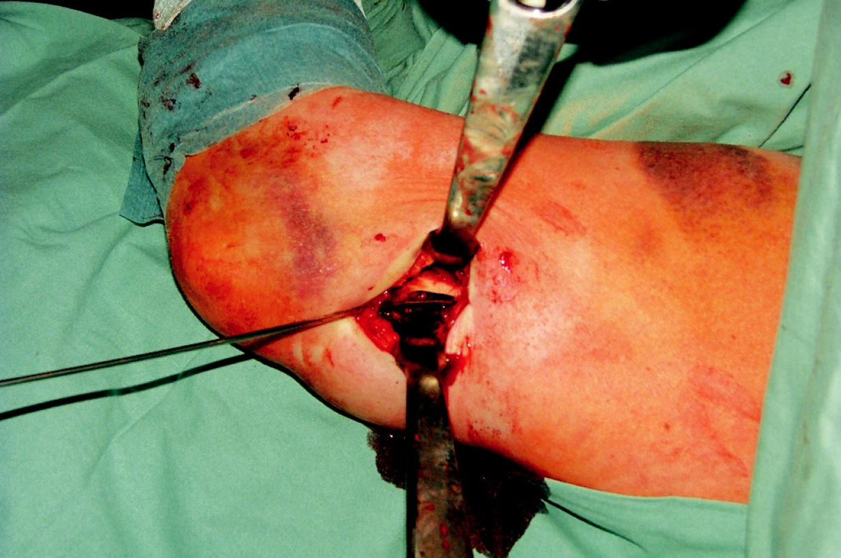 Foto – operační přístup k distálnímu humeru s trepanací vstupního otvoru cca 2 cm nad fossa olecranií a zavedením prvního K drátu
Fig. 11. Surgical approach to the distal humerus with trepanation of the entrance opening cca 2 cm above the olecranon fossa and introduction of the first K-wire