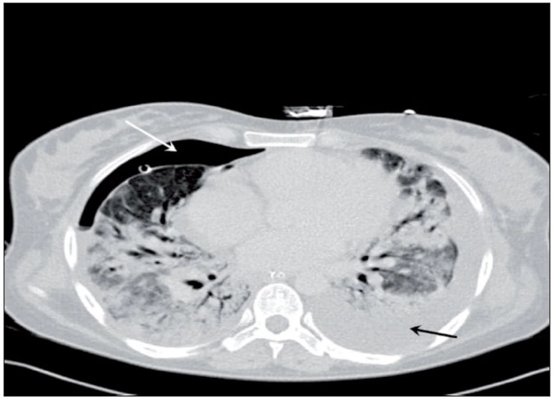 CT plic – extenzivní parenchymové konsolidace s negativním bronchogramem a ventrálním pneumotoraxem vpravo (bílá šipka) 
Pneumotorax přetrvával i přes správnou polohu hrudního drénu. Je patrný také hrudní výpotek vlevo před drenáží (tmavá šipka).
