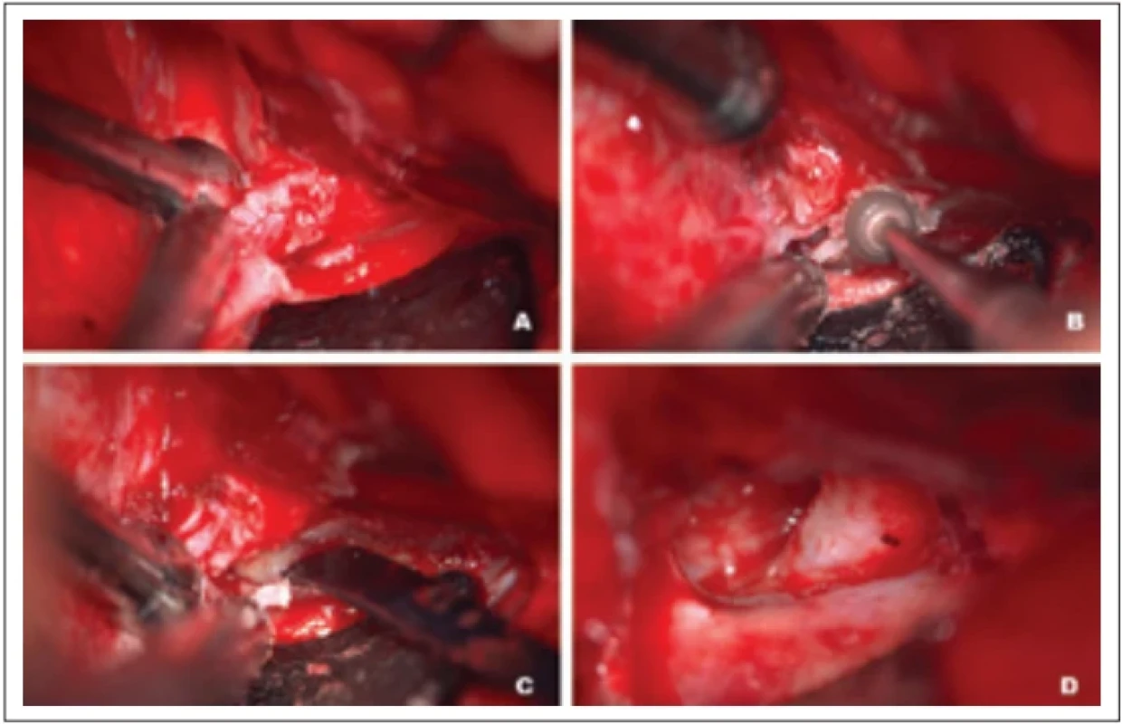  Intraoperačný nález: (A) prerušenie meningoorbitálneho pruhu; (B) odfrézovanie ala minor ossis sphenoidalis s nálezom dutiny pri pneumatizácii processus clinoideus anterior; (C) mukoidný obsah dutiny; (D) dekomprimovaný nervus opticus po odstránení tkaniva mukokély Fig. 2. Intraoperative fi nding: (A) disconnection of meningoorbital band; (B) drilling of lesser wing of the sphenoid bone showing pneumatised cavity inside the anterior clinoid process; (C) mucoid contents of the cavity; (D) decompressed optic nerve after exstirpation of the mucocele