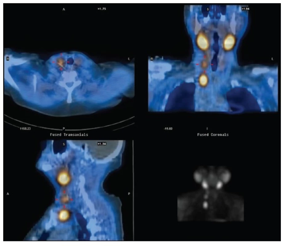 Reoperace u téže pacientky jako na Obr. 1 – recidiva jednak na krku, jednak v horním mediastinu s nutností parciální podélné sternotomie
Fig. 2: Reoperation in the same patient as in Fig. 1 – recurrence in the neck and in the upper mediastinum with the necessity of partial longitudinal sternotomy