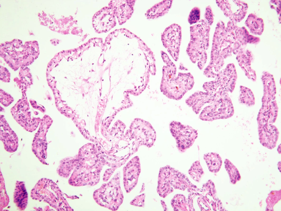Preparát farbený hematoxyllin-eosinom ukazuje papilárny charakter lézie