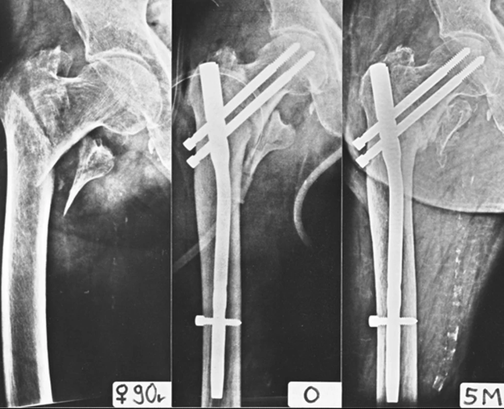 Vliv medio-laterálního zakřivení hřebu na lokalizaci místa vstupu (entry point): a – nestabilní pertrochanterická zlomenina; b – osteosyntéza PFN (Beznoska) s medio-laterálním zakřivením 10°, kdy místo vstupu je v laterální kortikalis velkého trochanteru, přesto se střední část dříku opírá o mediální kortikalis diafýzy; c – zlomenina 5 měsíců po operaci zhojena.
Fig. 13: Effect of medial-lateral curvature of the nail on location of the entry point: a – an unstable pertrochanteric fracture; b – internal fixation by PFN (Beznoska) with 10° mediallateral curvature when the entry point is located in the lateral cortex of the greater trochanter; in spite of this the middle part of the stem rests against the medial cortex of the femoral shaft; c – healed fracture 5 months after operation.