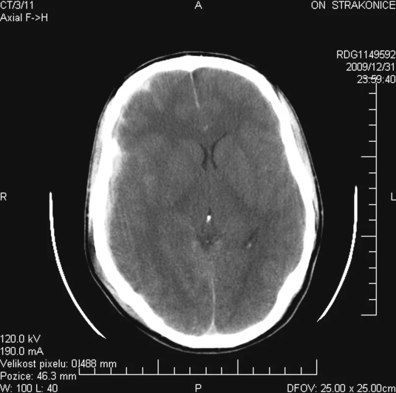 Iniciální CT s nálezem akutního subdurální hematomu nad pravou hemisférou mozku. Přetlak středočárových struktur byl 6 mm
Fig. 1. Baseline CT detecting acute subdural hematoma over the right cerebral hemisphere with a 6 mm shift of cerebral midline structures