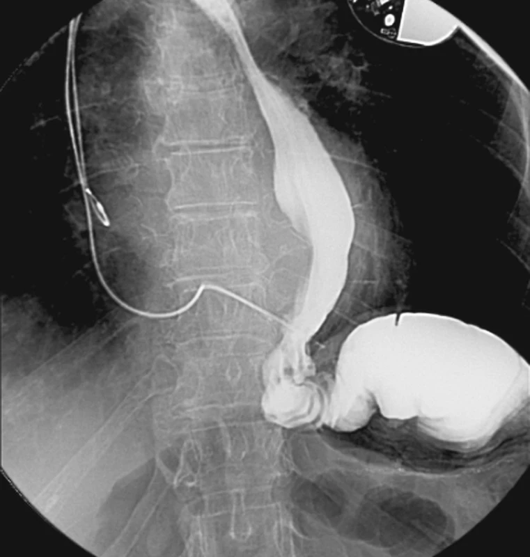 Stav po balónové dilataci striktury ezofagojejunoanastomózy
Fig. 5. Condition following balloon dilation of the esophagojejunal stricture