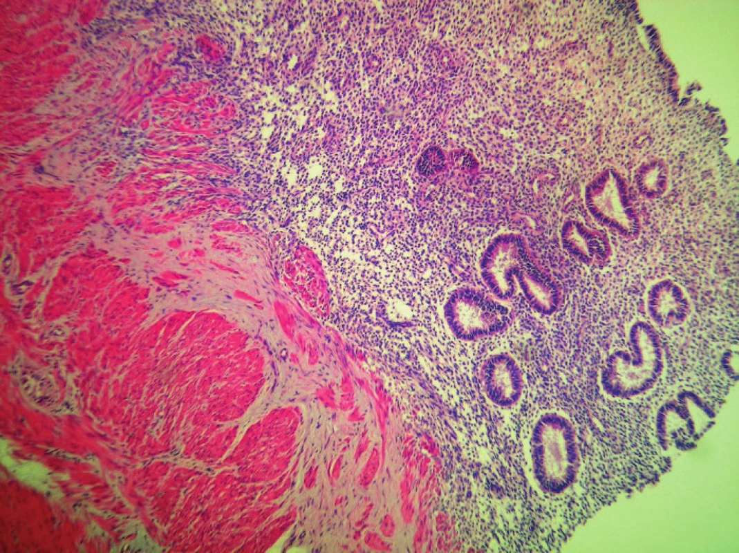 Stena hrubého čreva, na seróznom povrchu a v muscularis propria so štruktúrami endometriózy, HE 40x
Fig. 3: Intestinal tissue infiltrated with endometrial cells and stroma, HE 40x