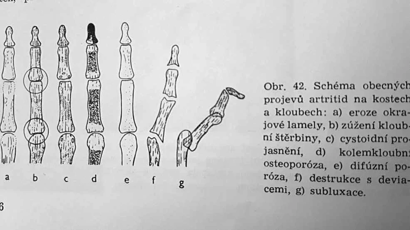Schéma obecných projevů artritid na kostech a kloubech