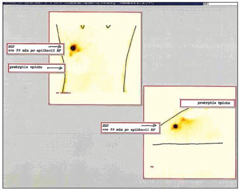 Gamagrafický obraz SU (Wereb, M., 2010)
Fig. 2. Gamagraphic view of the sentinel lymph node (Wereb, M., 2010)