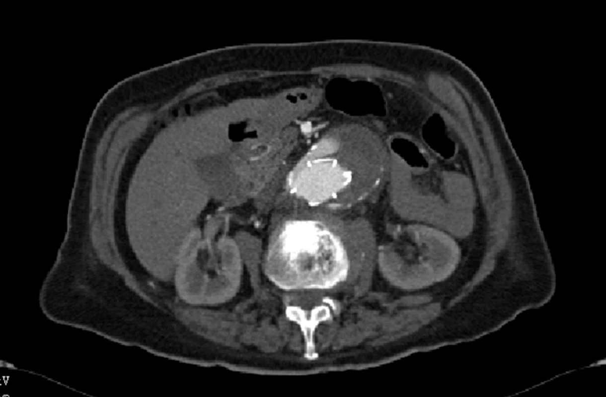 CTA obraz proximálního endoleaku I. typu
Fig. 1: CTA image of the proximal type I endoleak