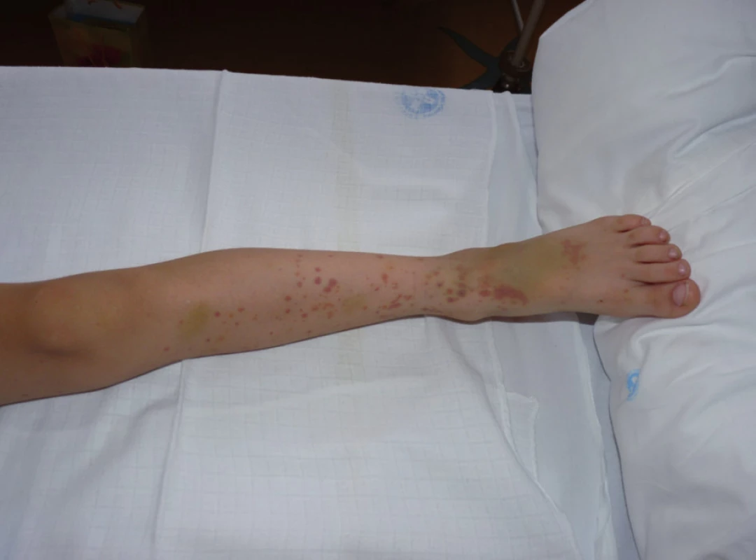 Kožní purpura. Různá vývojová stadia lézí a podkožní prosáknutí v oblasti nártu.
Fig. 1. Cutaneous purpura. Various developmental stages of the lesions and subcutaneous edema of the instep of the foot.