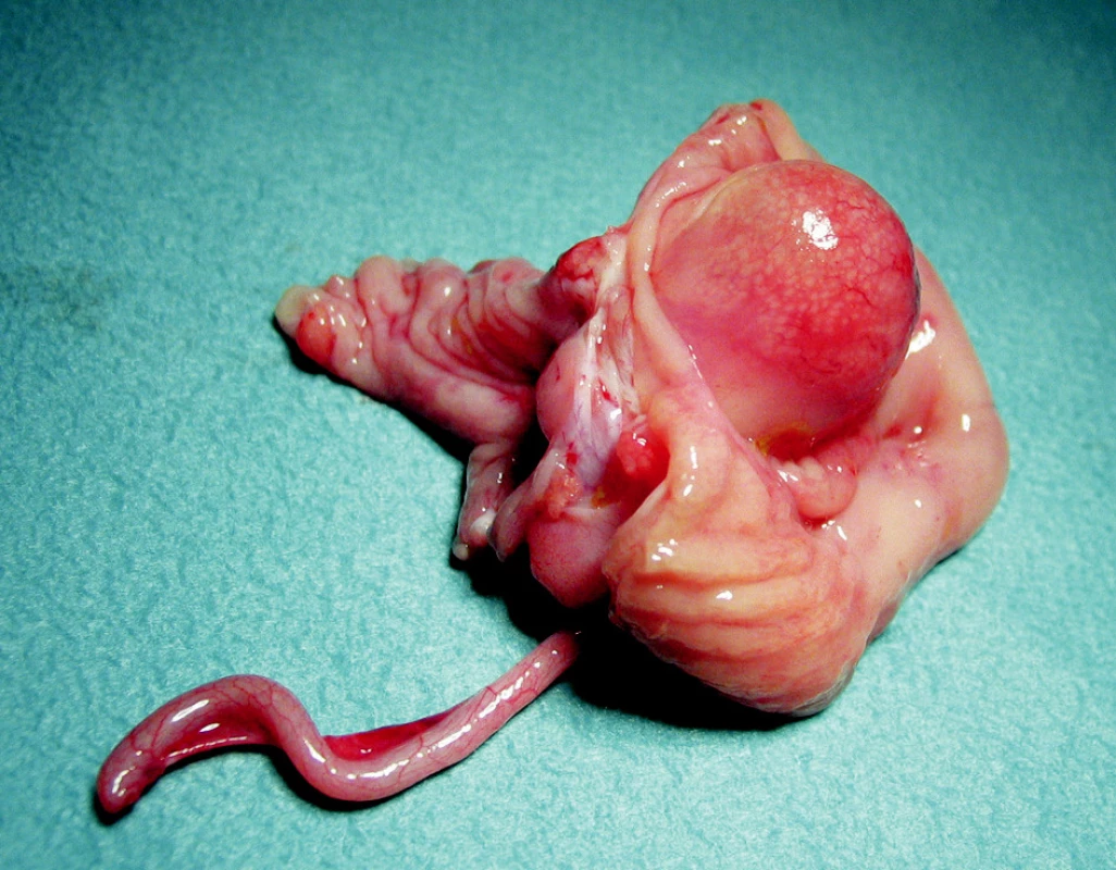 Črevný resektát s ovoidnou črevnou duplikatúrou obturujúcou lúmen v ileo-cekálnej oblasti
Fig. 6. A intestine resecate with its ovoid duplicature obturating the ileocecal lumen