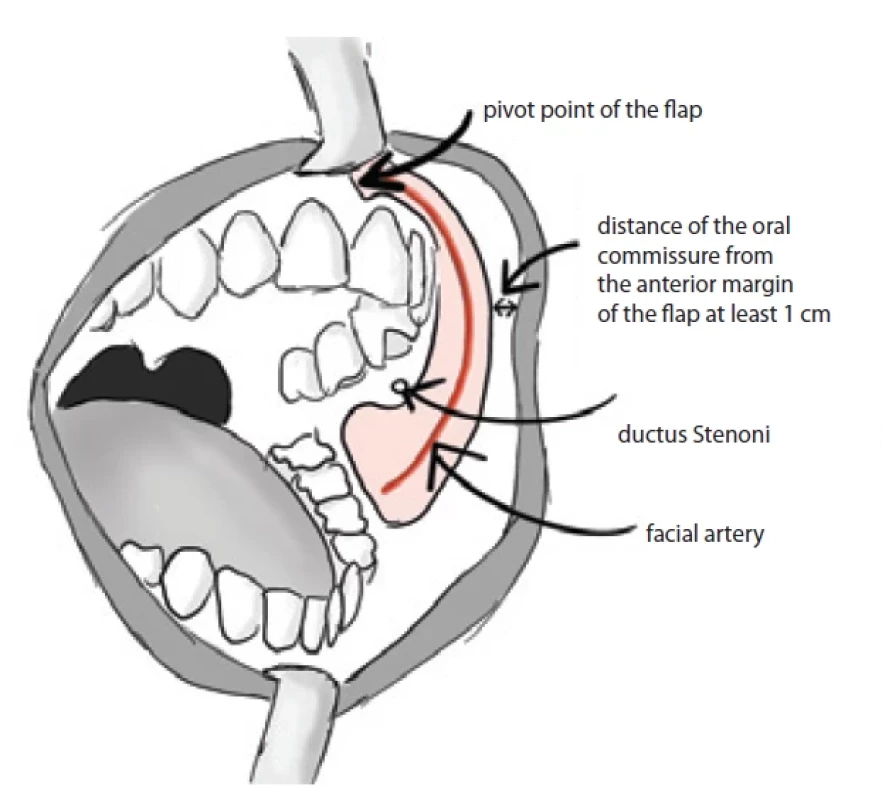 Diagram of the oral cavity with drawing of the facial artery musculomucosal fl ap. (Drawing by A. Berkeš).