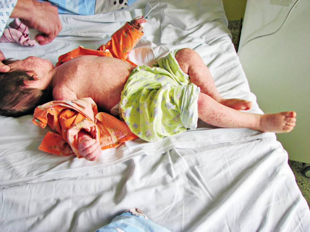 Spalničky – exantém.
Fig. 1. Measles – exanthema.