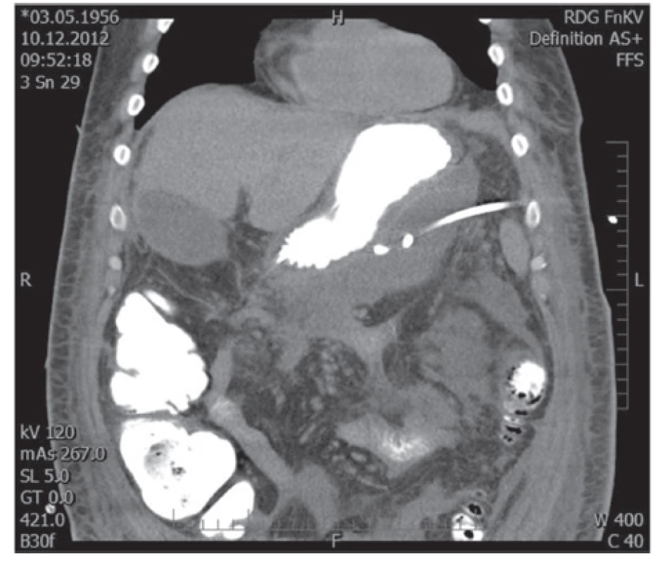 Drén zavedený do kolekce infikované tekutiny vlevo od žaludku
Fig. 1: Drain inserted into the fluid collection left-sided of the stomach
