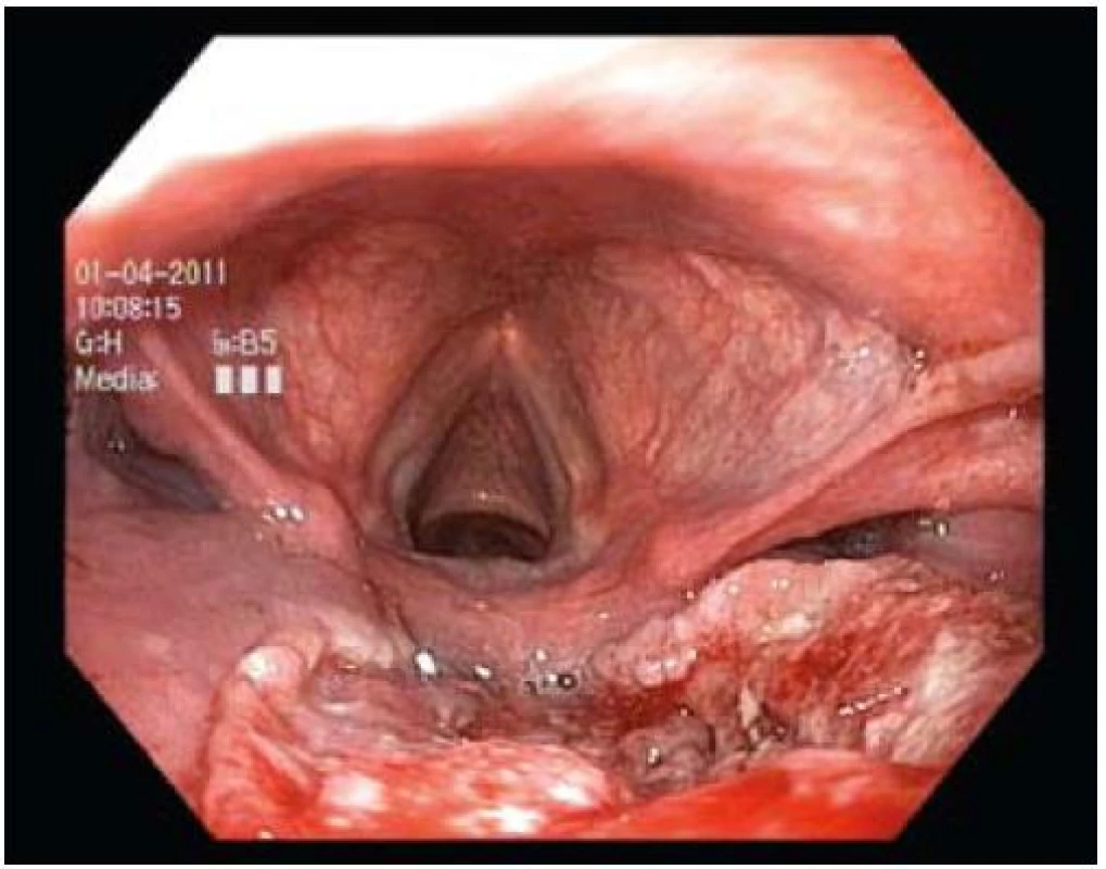 Karcinom zadní stěny hypofaryngu.
Fig. 4. Carcinoma of the posterior wall of the hypopharynx.