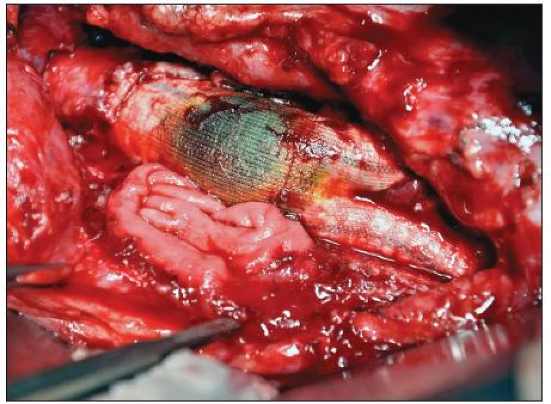Sekundární aortoduodenální píštěl
Fig. 1. Secondary aortoduodenal fistula