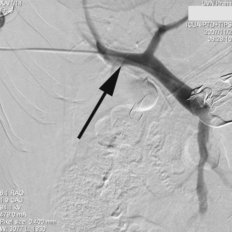 Transhepatálním přístupem provedena přímá portografie zavedeným diagnostickým 5F katétrem (šipka), únik kontrastu neprokázán
Fig. 1. Direct transhepatic portography with a 5F diagnostic catheter introduced (arrow), no evidence of the contrast leakage
