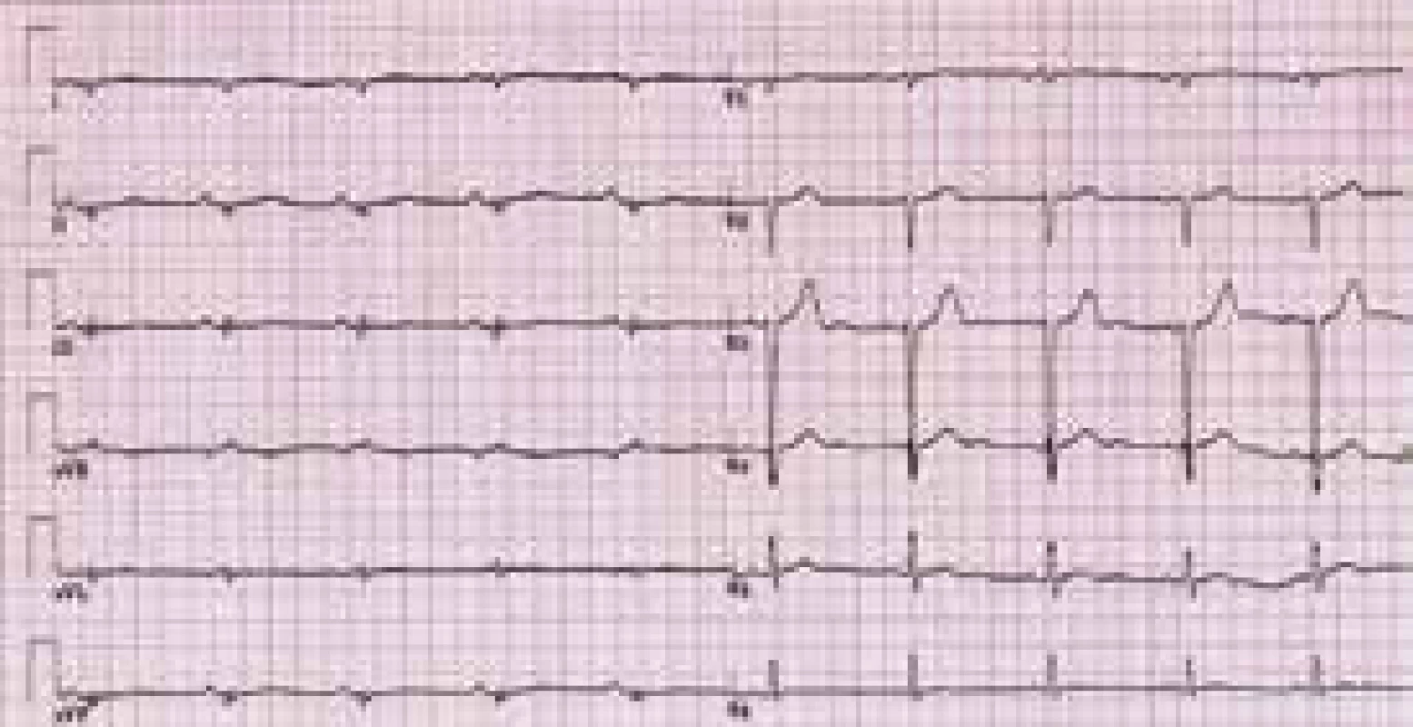 EKG pacienta s arytmogenní kardiomyopatií levé komory